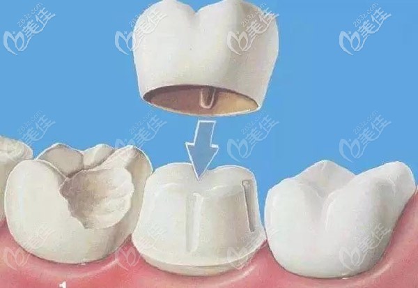 那根管后做牙冠和嵌体哪个实用性更高呢？