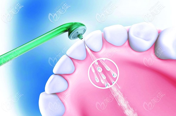 洗牙后的注意事项 洗牙后的注意事项