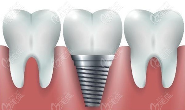 齐佳妮医生已完成200多颗牙齿种植 齐佳妮医生已完成200多颗牙齿种植