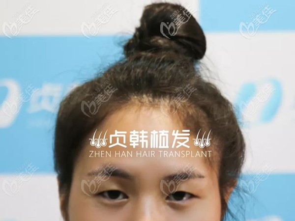 种眉毛前拍的照片 种眉毛前拍的照片