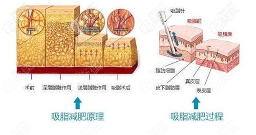 杨柳医生吸脂技术