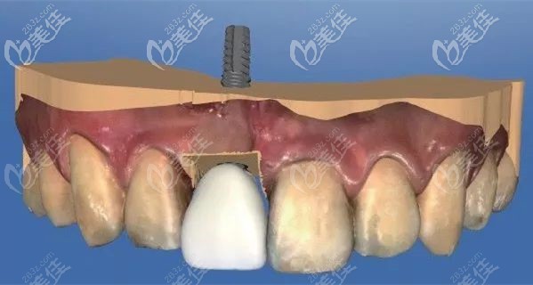 前牙美学种植示意图