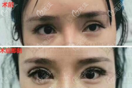 张莹莹双眼皮修复真人术前术后即刻对比照 张莹莹双眼皮修复真人术前术后即刻对比照
