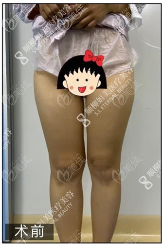 大腿抽脂手术前 大腿抽脂手术前