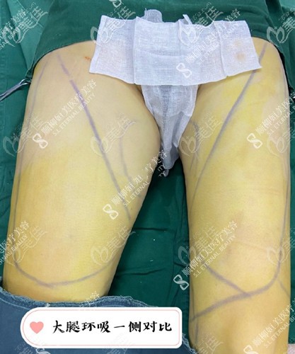 大腿环吸手术过程 大腿环吸手术过程