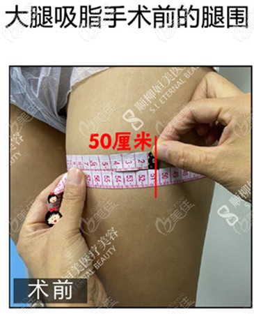 抽脂钱腿围50厘米 抽脂钱腿围50厘米