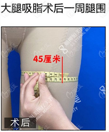 抽脂后腿围45厘米 抽脂后腿围45厘米