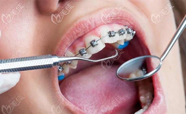 长春环球口腔的牙齿矫正价格表
