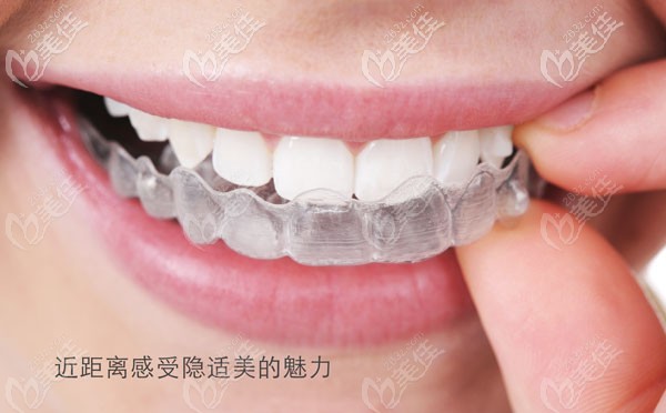 长春环球口腔的隐适美牙套图