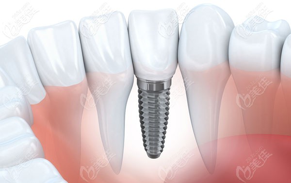 这是环球口腔的牙齿种植价位  