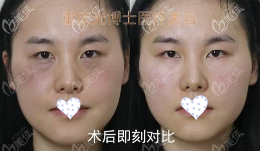 嗨体熊猫针去泪沟效果图 嗨体熊猫针去泪沟效果图