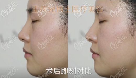 90°效果 90°效果