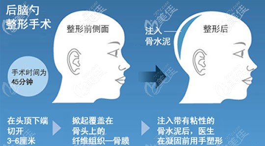 骨水泥填充后脑勺效果及手术步骤 骨水泥填充后脑勺效果及手术步骤