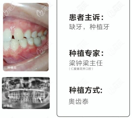 22岁不想戴假牙,在武汉仁爱口腔喜提一颗价格适中的数字化奥齿泰种植牙