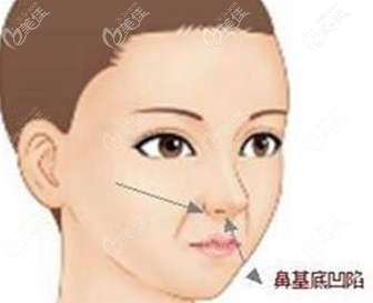 鼻基底凹陷示意图
