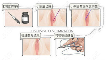 小阴唇手术过程图解