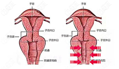 阴道紧缩过程图示