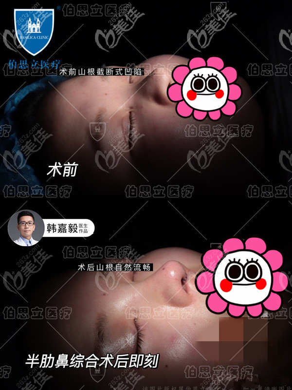 分享上海高难度隆鼻案例韩嘉毅半肋软骨鼻综合28天就吸收好