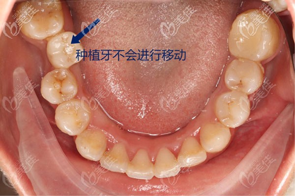 缺牙和牙齿不齐的情况下，建议先矫正后种植