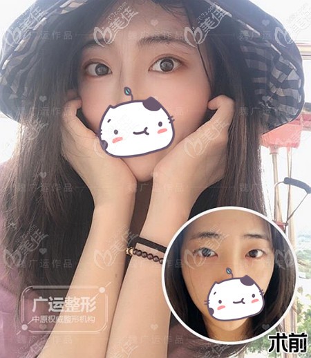 别再问我郑州医生割双眼皮怎么样了,直接看我做全切后的效果吧!