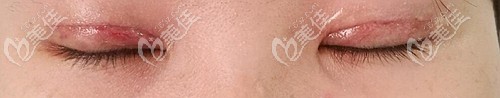 全切双眼皮术后前一个月 全切双眼皮术后前一个月