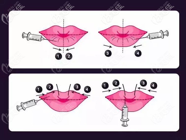 内部资料：去合肥斯尔美做M唇手术的术前术后即刻对比照，想了解的快来看