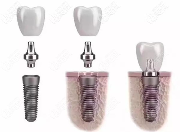 种植体常用的材料主要是纯钛及钛合金 种植体常用的材料主要是纯钛及钛合金