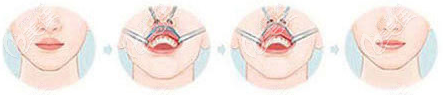 厚唇改薄手术过程示意图 厚唇改薄手术过程示意图