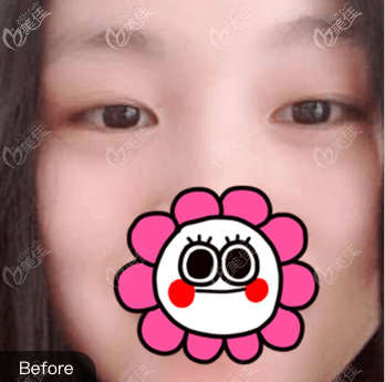 做全切双眼皮前 做全切双眼皮前