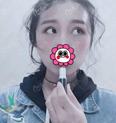 做完全切双眼皮1个多月 做完全切双眼皮1个多月