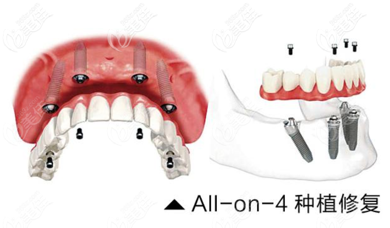 全口种植牙的费用 全口种植牙的费用