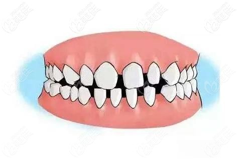 整牙，牙齿稀疏