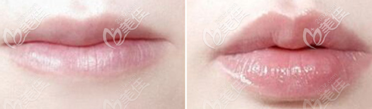 自体脂肪丰唇效果图参考 自体脂肪丰唇效果图参考