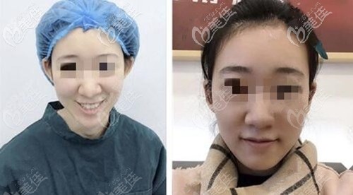 赵翊利院长招风耳矫正案例