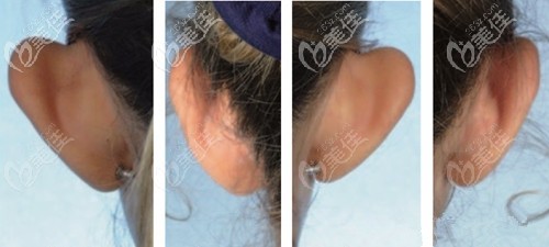 余文林医生招风耳矫正案例