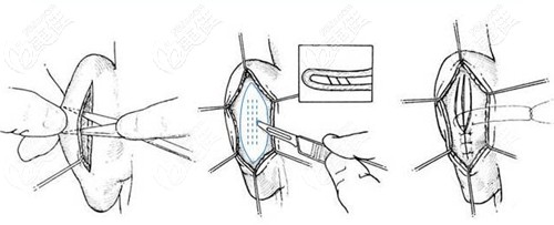 余文林招风耳矫正手术