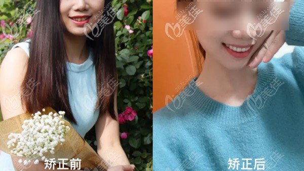 想知道拔了8颗牙齿后戴时代天使是什么感受？拔牙矫正前后对比图来喽