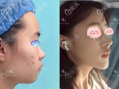 王召东鼻综合案例