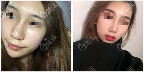 逢宝峰鼻综合案例