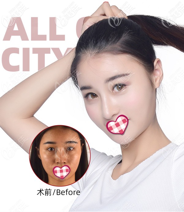 成都恒博天姿自体脂肪面部填充案例效果