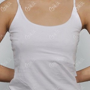 术前胸部平坦 术前胸部平坦