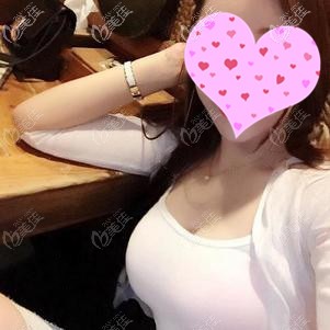 聂志宏医生为我做假体隆胸手术效果 聂志宏医生为我做假体隆胸手术效果