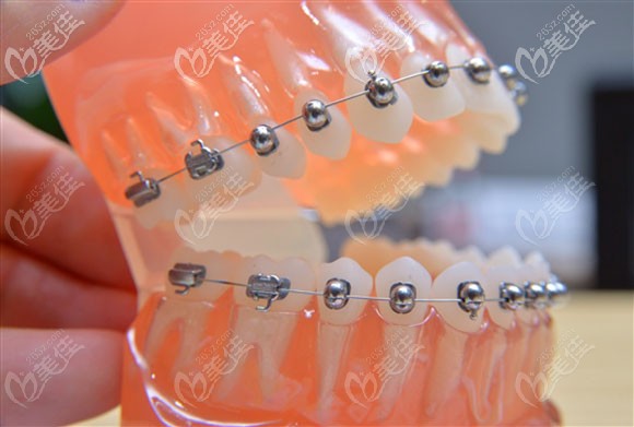 宝妈现身忠告:在长春环球口腔戴牙套矫正的真实经历+价格+医生+技术评价分享！