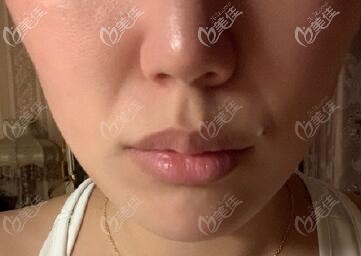 鼻基底凹陷照片 鼻基底凹陷照片