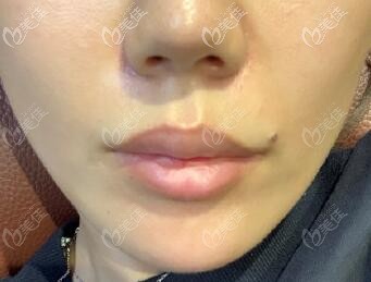 膨体垫鼻基底效果图 膨体垫鼻基底效果图