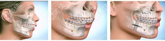 代偿性正畸 代偿性正畸