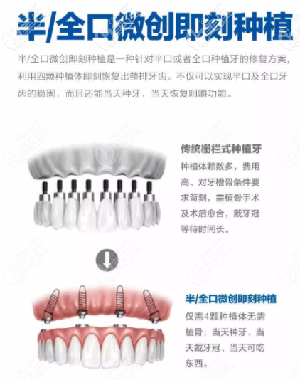 全口即刻种植优势