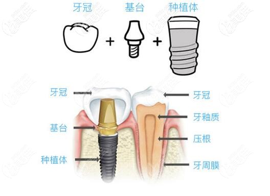 兰州皓亚口腔种植牙