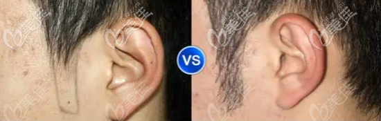 鬓角种植前后对比图 鬓角种植前后对比图