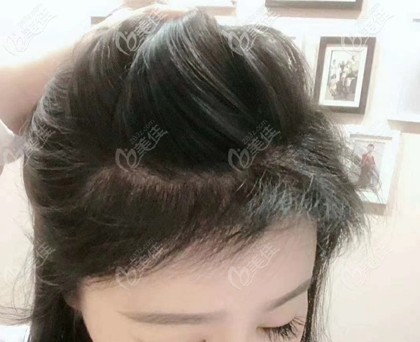 深圳鹏程发际线植发6个月效果图 深圳鹏程发际线植发6个月效果图